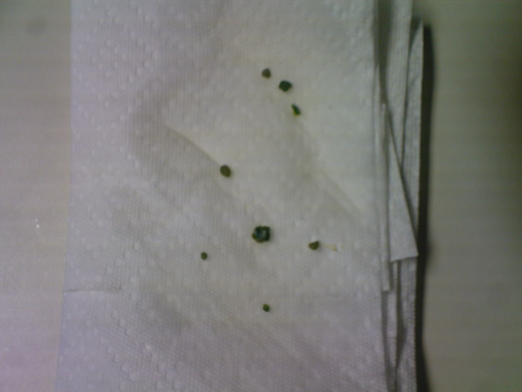 gallstones