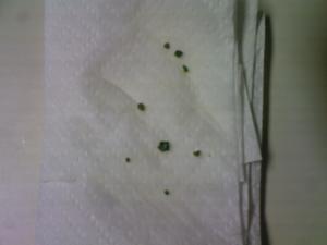 gallstones